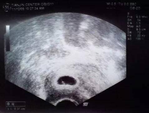 怀孕多久可以看见胎心胎芽 胎囊胎芽胎心形成时间