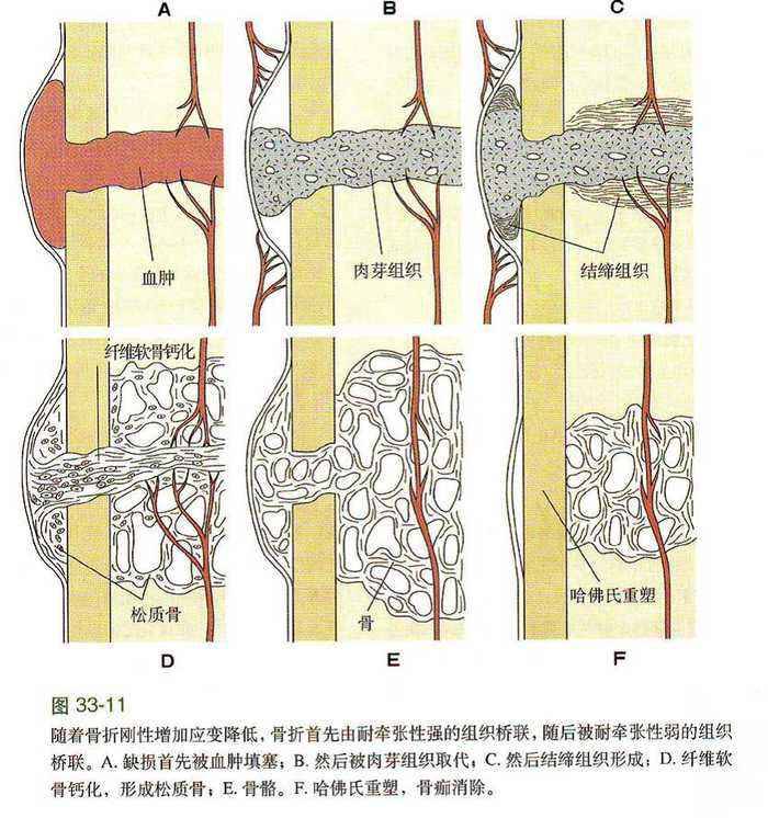 骨折是怎么愈合的