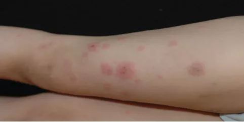 孩子身上出现又红又痒的疹子，过敏还是水痘？怎么办？