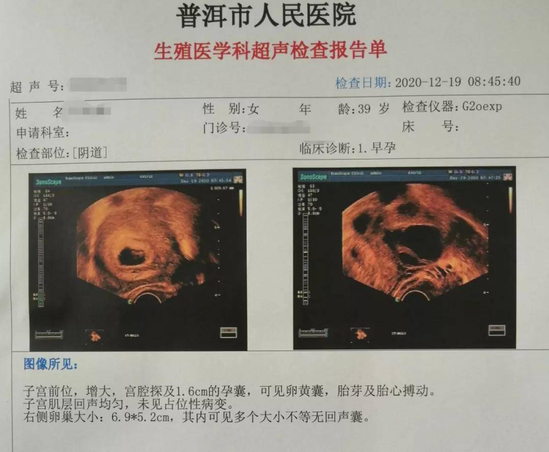 喜讯 | 普洱市人民医院首例试管婴儿成功妊娠