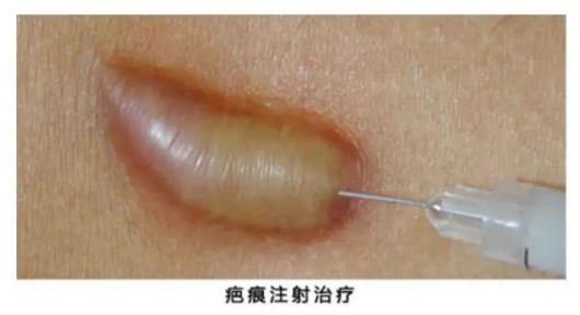 上海九院孙沣博士：修复疤痕有哪些方法？较好的治疗时间是多久？