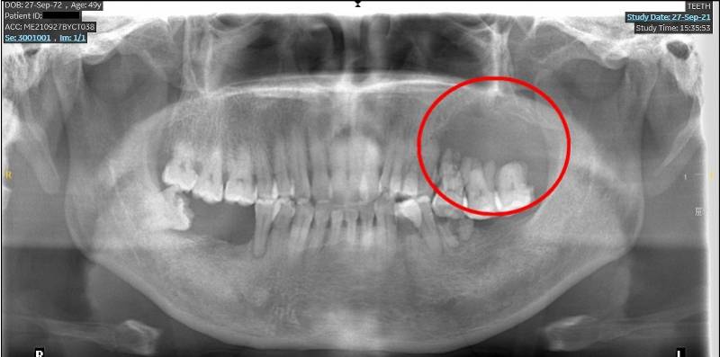 牙龈也能长癌而且吞噬颌骨，牙齿松动等早期信号别忽视
