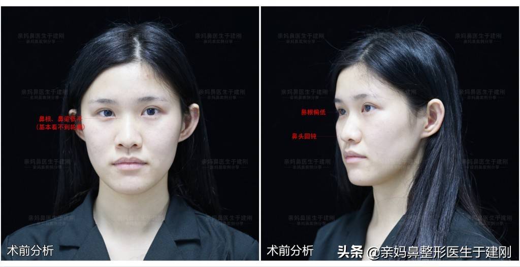 22岁湖南姑娘，鼻头圆钝、鼻尖下垂，隆鼻45天后能变得多美？