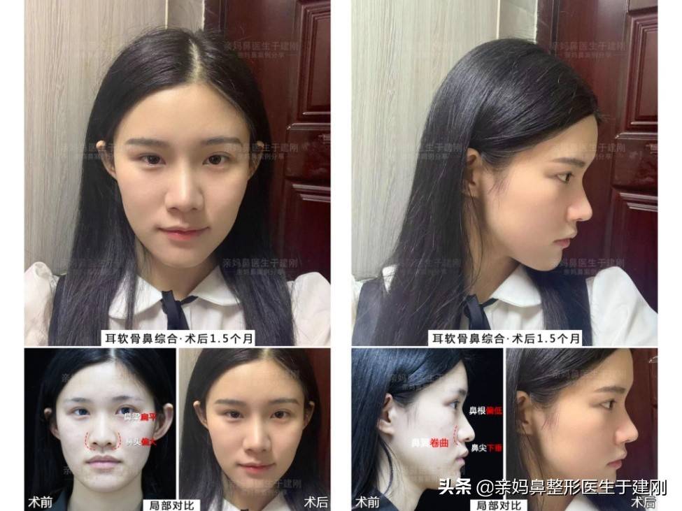 22岁湖南姑娘，鼻头圆钝、鼻尖下垂，隆鼻45天后能变得多美？