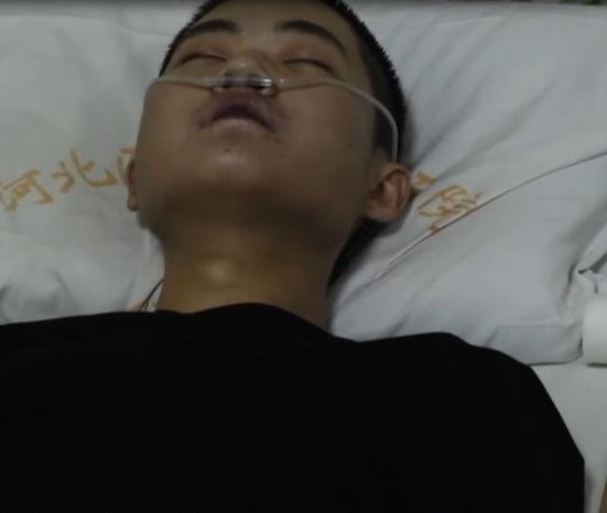 23岁男子百草枯中毒记录：抢救27天，最终无法呼吸，窒息而死