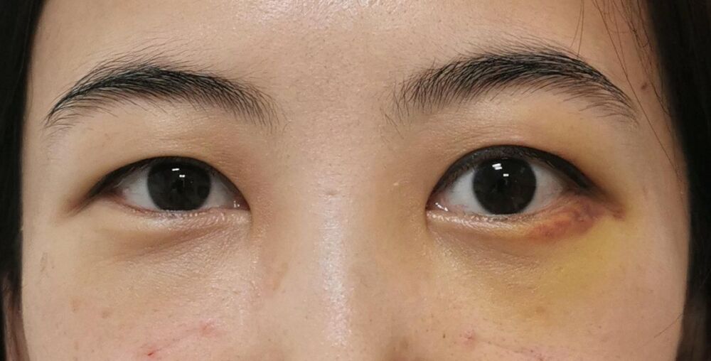 41岁美女眼袋手术后视力下降？医生：这7种风险须小心