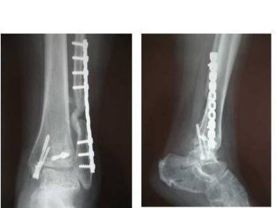踝关节骨折内固定手术后该注意哪些东西呢？
