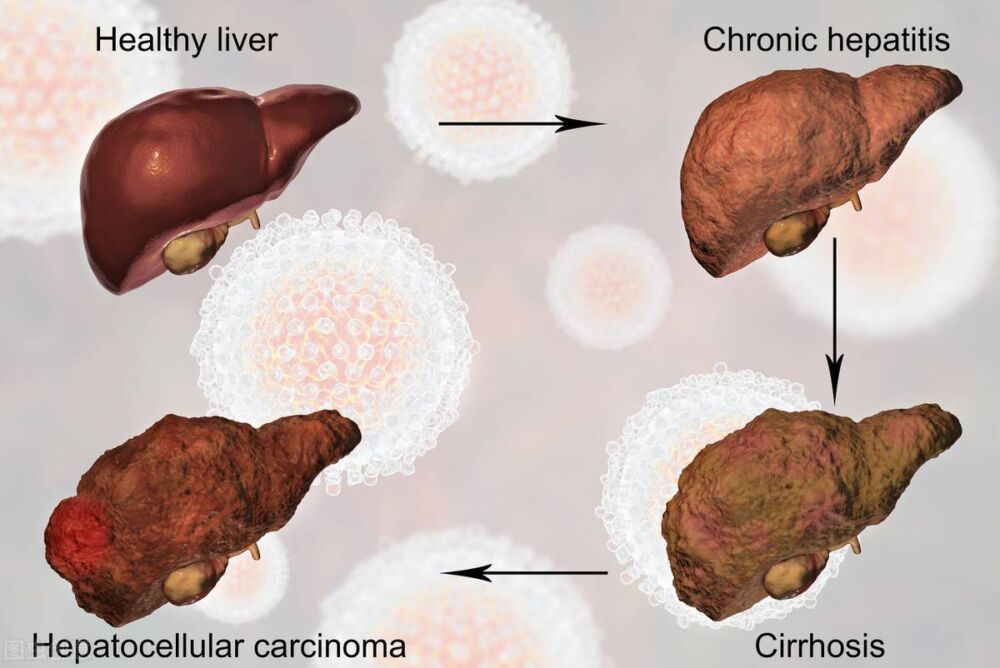 慢性乙肝、肝硬化生存期研究，哪些因素影响了肝硬化患者的生存期
