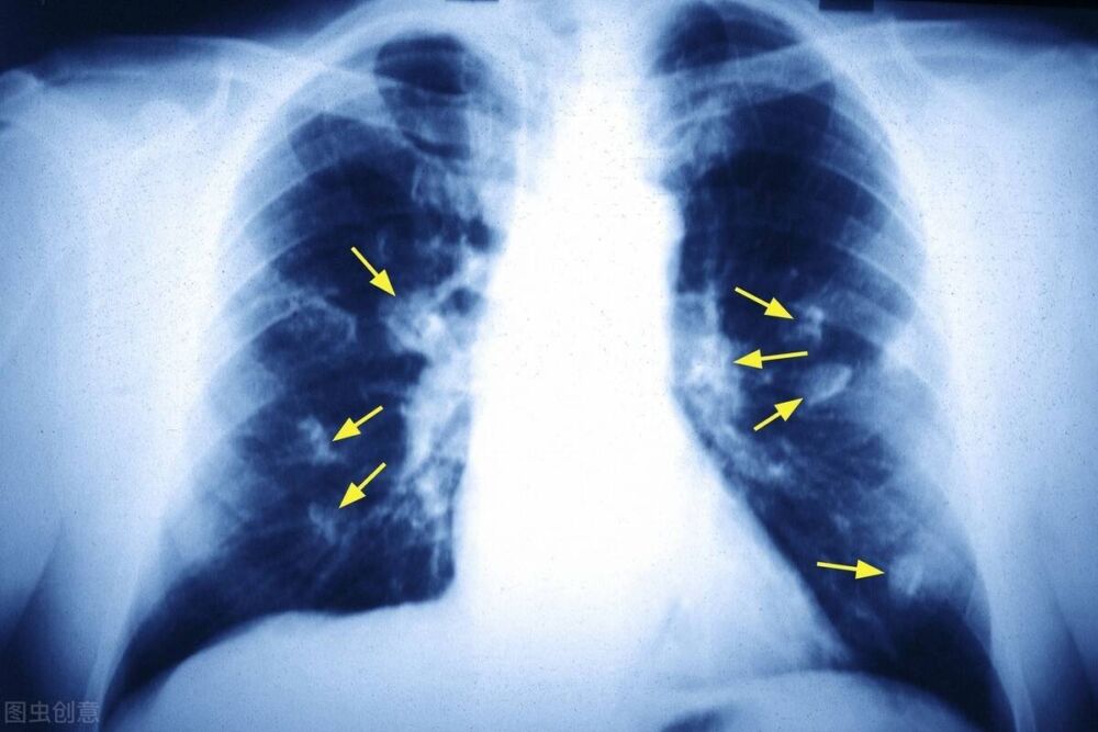 肺癌骨转移能活多久？四肢无力，不停咳嗽，怎么才能提高生活质量