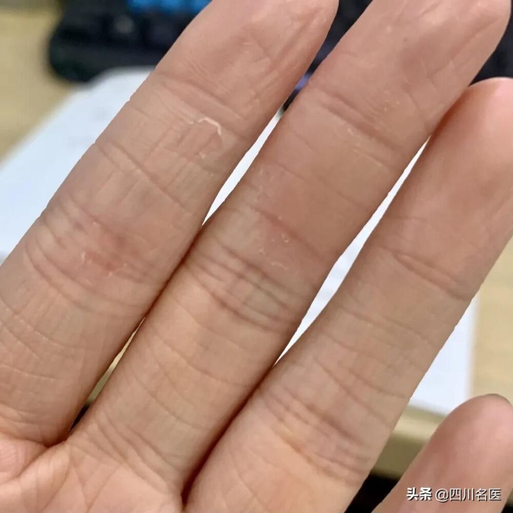 你的手为什么老脱皮？原因竟不是缺维生素
