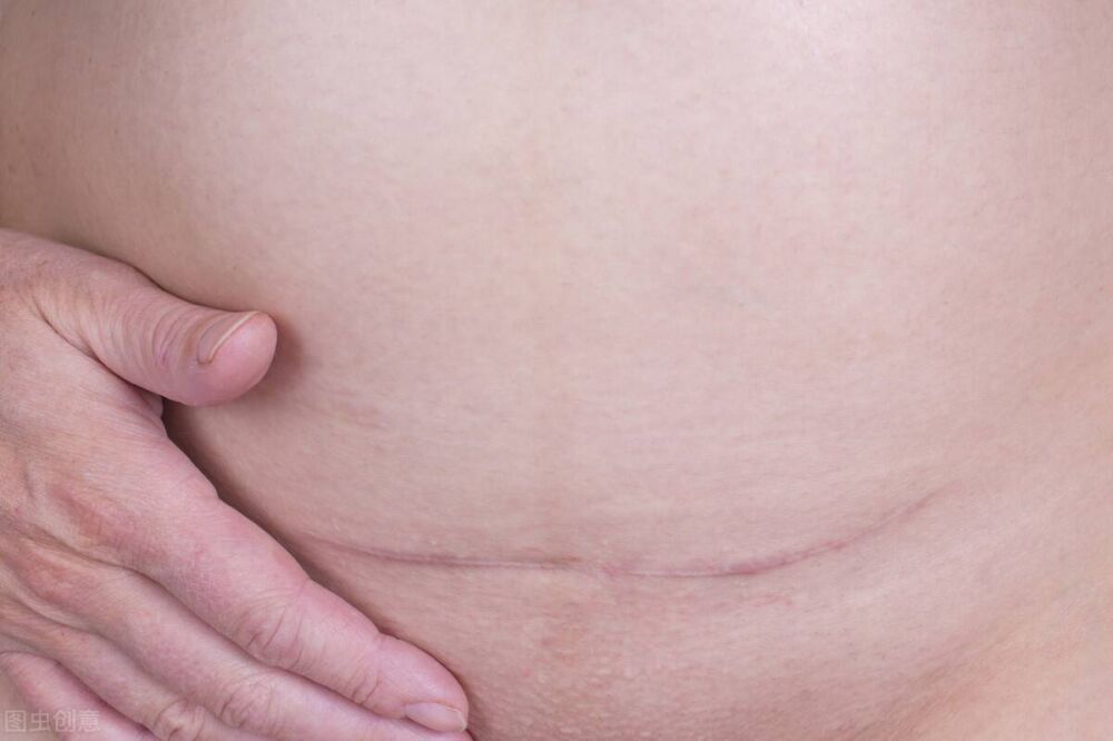 剖宫产术后伤口痒怎么办？