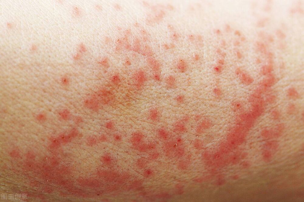 湿疹是真菌感染吗？湿疹的症状有哪些？
