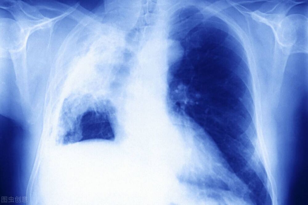 肺癌骨转移能活多久？四肢无力，不停咳嗽，怎么才能提高生活质量