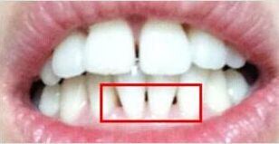 牙龈发黑，刷都刷不掉是什么引起的？该怎么补救？