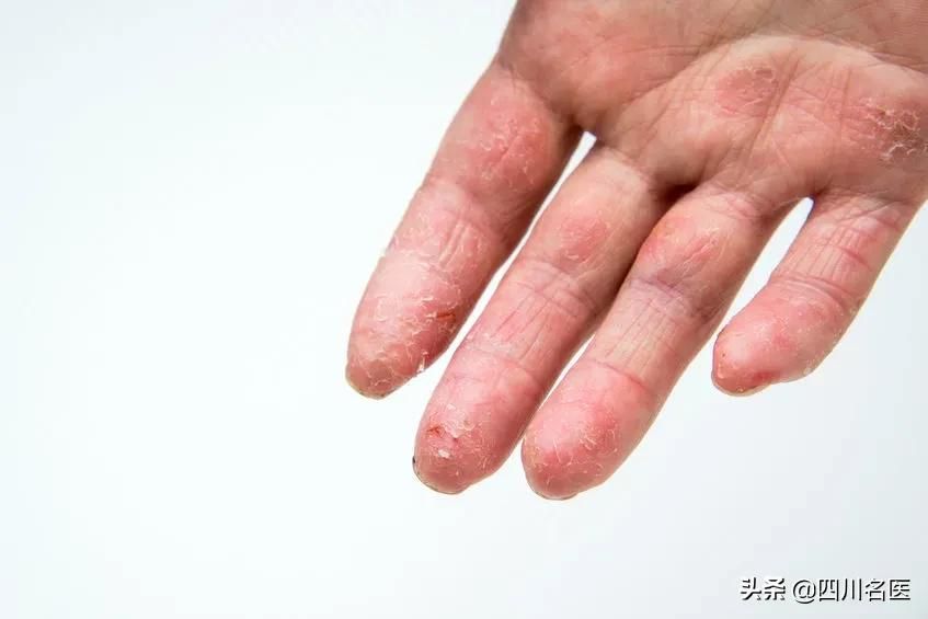你的手为什么老脱皮？原因竟不是缺维生素