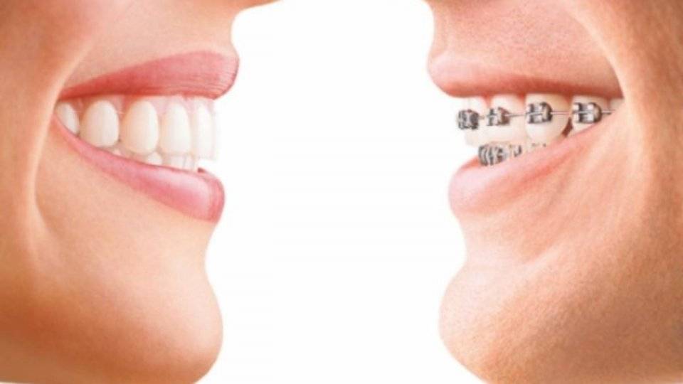 戴牙套就会出现牙套脸？矫正期间，怎么预防牙套脸？