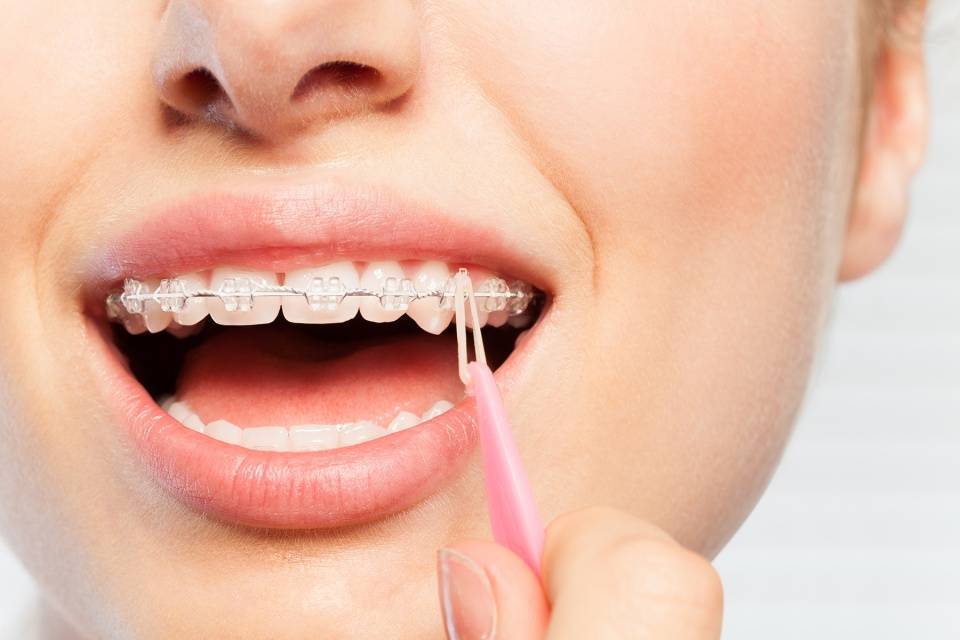 戴牙套就会出现牙套脸？矫正期间，怎么预防牙套脸？