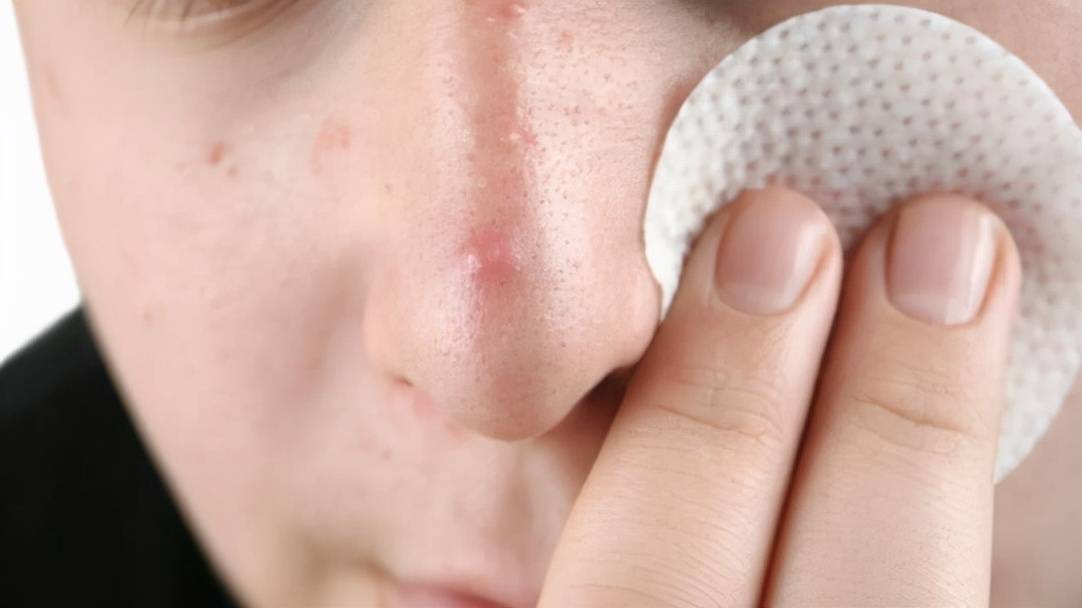 你知道吗？鼻子痘痘位置不同，问题也不同「洛阳肤康」