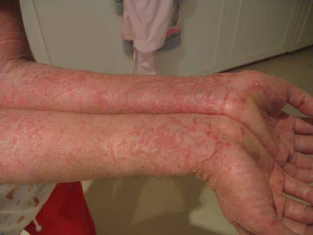 脱皮的病因不止干燥和洗衣粉，真菌和寄生虫才是更可怕的问题