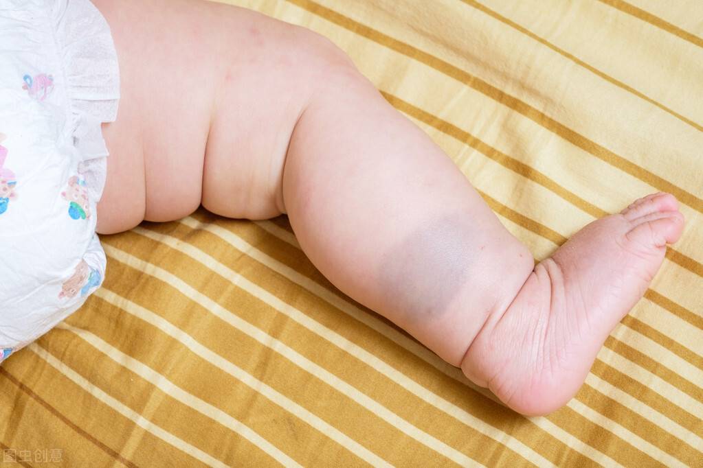 为什么宝宝会有胎记？什么时间治疗最佳？