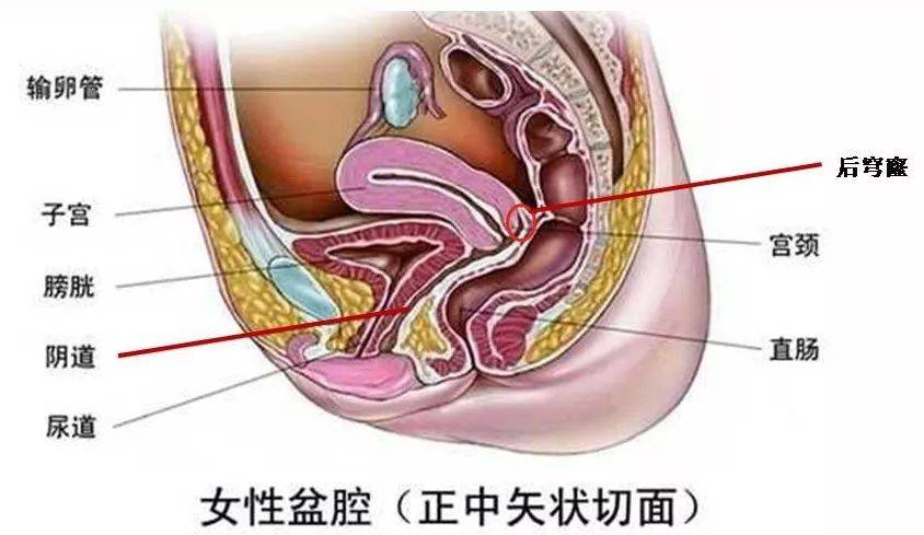 阴道的不完全说明书