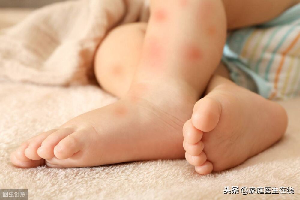 5个因素，会让宝宝长湿疹，家长平时注意一点
