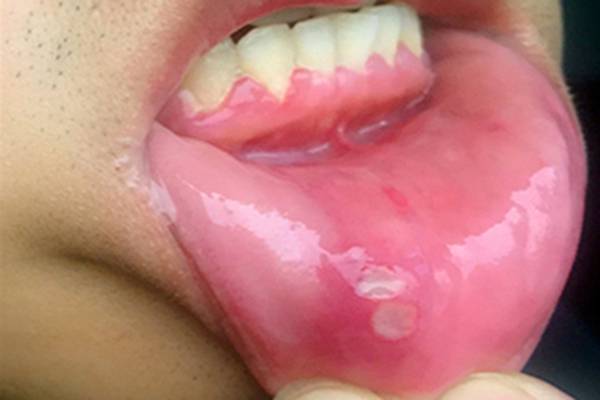 口腔长溃疡，经常反复，可能是什么原因？