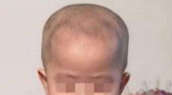 孩子的头大、头小、偏头，方颅，是什么原因？一次性弄清楚