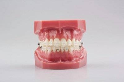 牙套有哪几种，哪种矫正牙齿好？