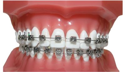 牙套有哪几种，哪种矫正牙齿好？