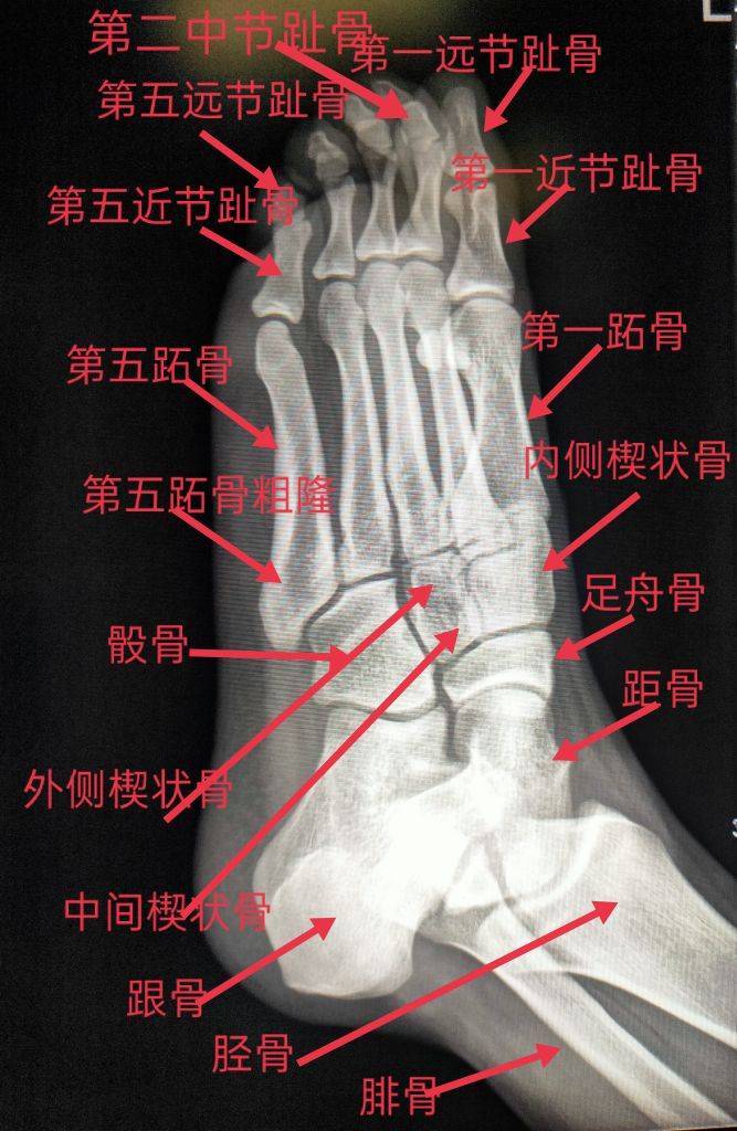 学习《X线读片指南》骨、关节系统——足