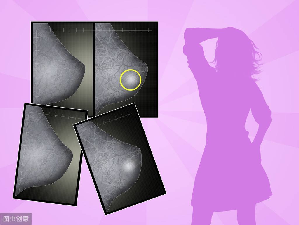 什么是乳腺结节？乳腺结节如何检查？该如何应对乳腺结节？
