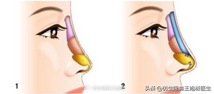 单纯隆鼻是什么，和综合隆鼻有什么区别？