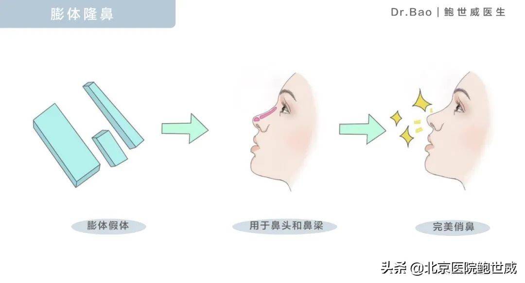 做了假体隆鼻，几年后会垮吗？