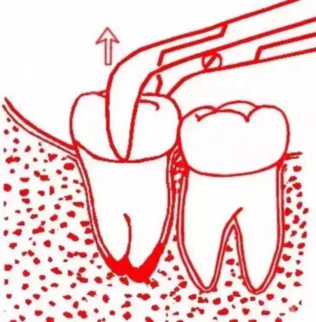 智齿的几种临床拔除术