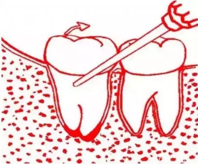 智齿的几种临床拔除术
