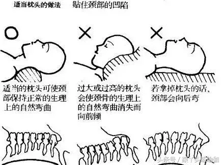 颈椎病轻重程度分十级，看看你是哪一种？