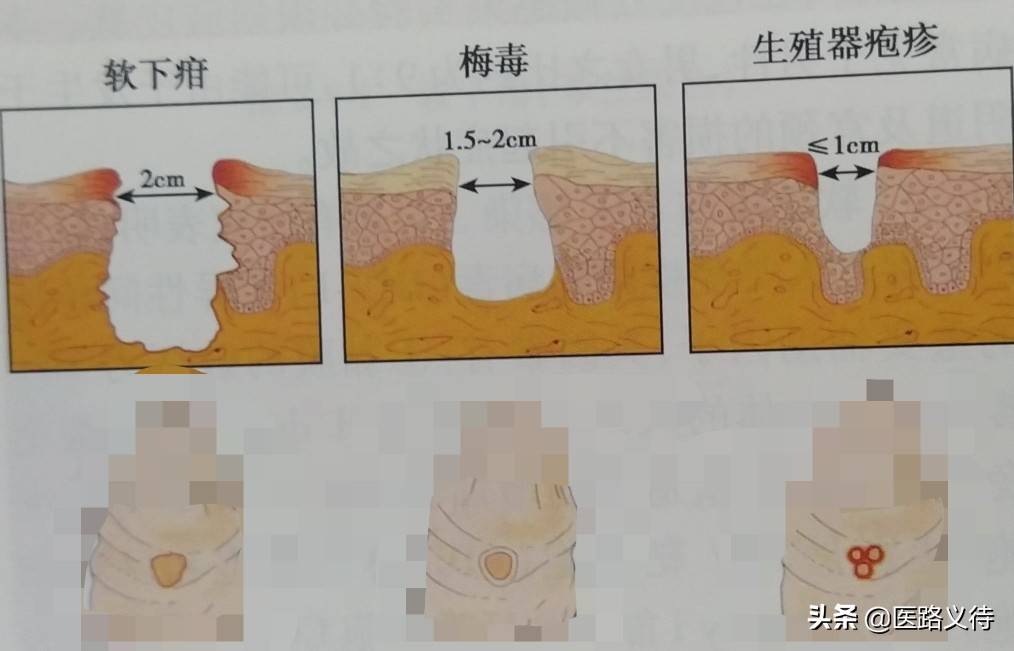 软下疳与硬下疳区别