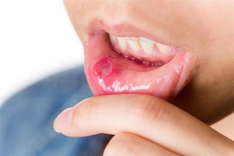 开不了口的痛，叫口腔溃疡！别顾着补充维B，3种药止痛防复发
