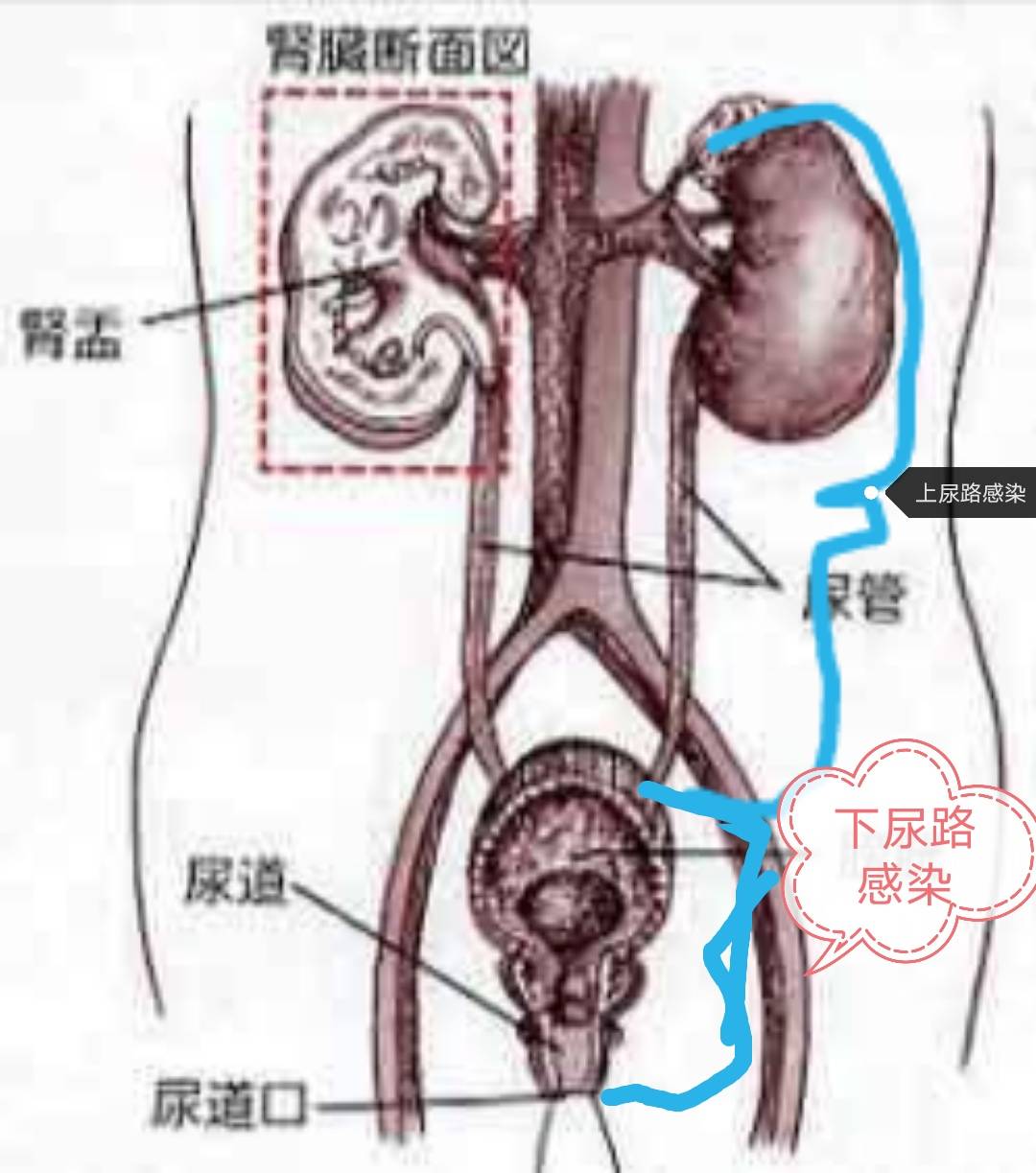 夏季常见病：尿频，尿急，尿痛的原因及治疗用药，附个人治疗经验