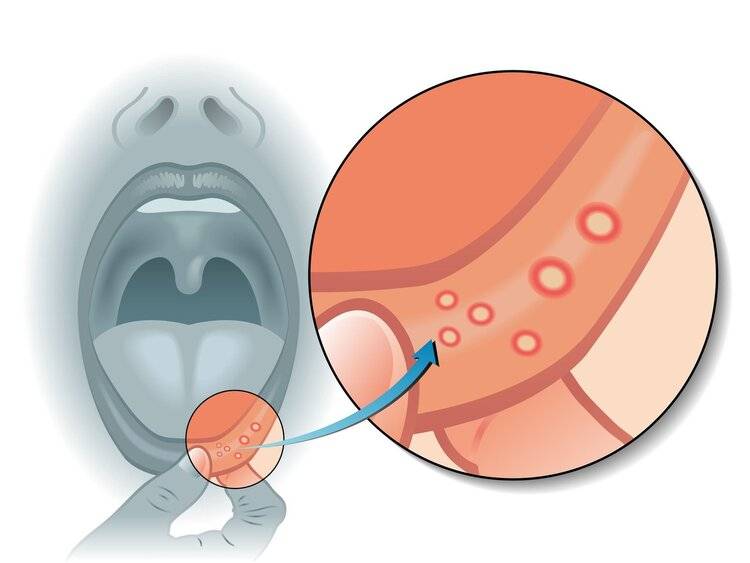 开不了口的痛，叫口腔溃疡！别顾着补充维B，3种药止痛防复发