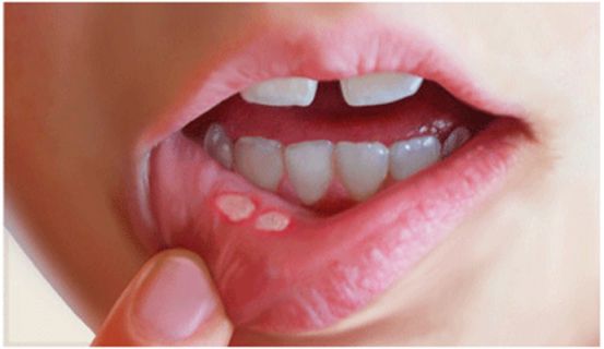 口腔癌最常见的6种症状，如果没有出现，那说明你的口腔很健康