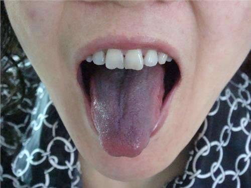 口腔科医生：为什么你的舌头颜色是黑的？