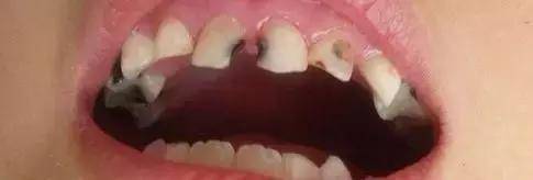 孩子牙齿上的黑斑是什么？看完你就懂了！