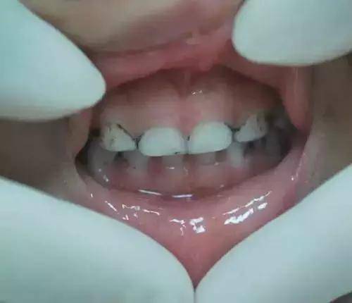 孩子牙齿上的黑斑是什么？看完你就懂了！