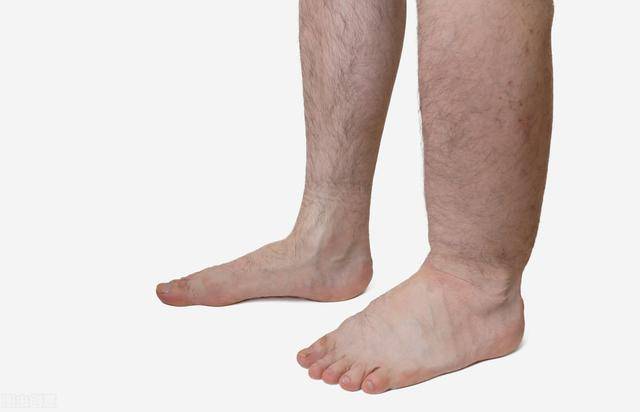 哪些疾病容易引起脚肿？听医生解疑脚肿原因和就诊推荐