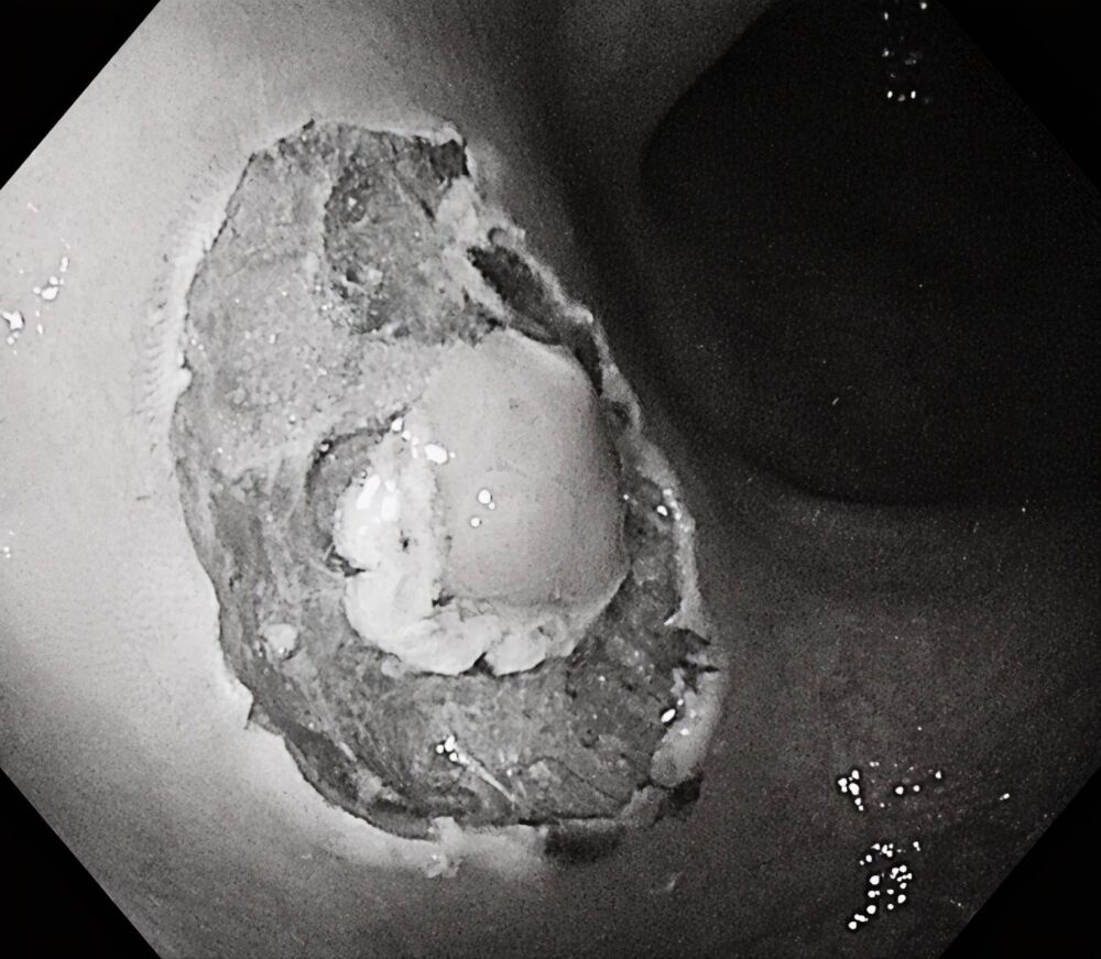 十分钟！无出血！不开刀也能切肿瘤——内镜粘膜下剥离术ESD
