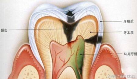 牙洞是怎么产生的？有哪些危害？有哪些治疗方法？