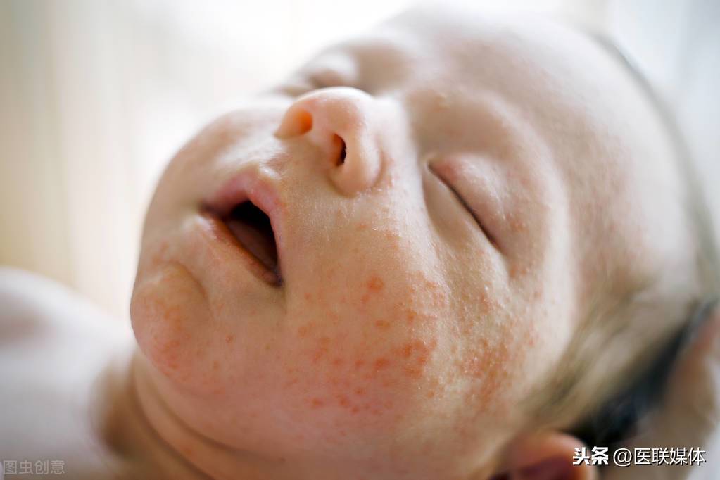 新生儿长湿疹怎么办？用这4招来搞定，不做“红宝宝”