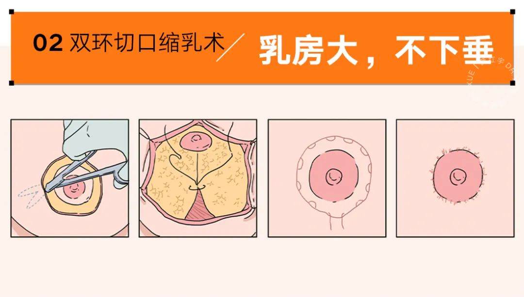 各类人群的乳房缩小术